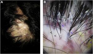 Foliculitis decalvante. A) Placa alopécica mal delimitada y de aspecto nacarado en el vértex y la zona parietal, con escaso eritema en la periferia. B y C) Tricoscopia: pelos en penacho (flechas azules), descamación y eritema peripilar (flechas verdes), costras amarillentas y parches blancos fibróticos sin aperturas foliculares (flechas negras).