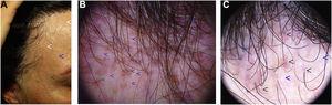 Alopecia frontal fibrosante. A) Alopecia marginal con retroceso de la línea de implantación frontotemporal del pelo. Pelos solitarios (flechas blancas), múltiples pápulas faciales color piel (flecha azul) y hundimiento de venas temporales (flecha verde). B y C) Tricoscopia: eritema y descamación perifolicular (flechas verdes), pelos solitarios y parches blancos sin aperturas foliculares (flechas azules). Nótese la ausencia de pelos vellosos.