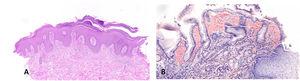 A) Biopsia punch de la lesión del codo, evidenciando acantosis, elongación de papilas, paraqueratosis focal con microabscesos de Munro y un infiltrado mixto inflamatorio dérmico, hallazgos demostrativos de psoriasis (HE 10×). B) Biopsia gástrica mostrando depósito de amiloide (rojo Congo 10×).