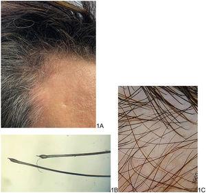 A) Reducción de la densidad pilosa en la región temporoparietal. B) Pelos en fase de telógeno. C) Aumento del porcentaje de los pelos vellosos mayor al 20%, integridad del tallo y ausencia de cabello miniaturizado.
