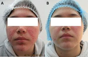 A) Angiofibromas faciales en el tratamiento con rapamicina monoterapia, previo al tratamiento con láser CO2. B) Evolución clínica tras 8 sesiones de tratamiento con láser CO2.