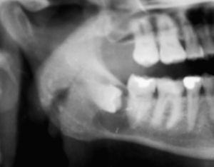 Ortopantomografía (OPG) de un quiste folicular: una secuela característica de un tercer molar mantenido in situ.