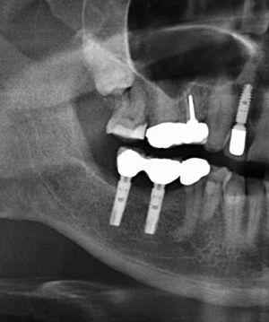 Imagen en la OPG de un tercer molar totalmente retenido. En este caso no está indicada la extracción profiláctica.