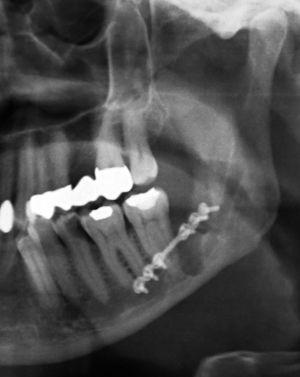 Ortopantomografía de una fractura tratada que se manifestó 4 semanas después de la osteotomía del diente 38.