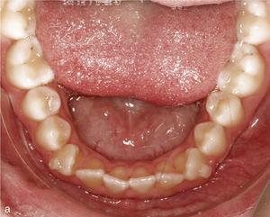 Vista intraoral d'arcada inferior amb dents rotats i apinyats, especialment les dents 33 i 43 (a). Es van col·locar ancoratges a les dents 33 i 43. Situació intraoral un cop finalitzat el tractament: arcada conformada després de la desrotación dels canins i dels incisius (b).