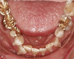 Sector anterior de l'arcada inferior amb dents rotats i apinyats (a). La conformació de l'arcada es realitza mitjançant l'extracció de la dent 42 i la col·locació d'ancoratges a les dents 33 a 44. Vista intraoral de l'arcada inferior amb un aspecte harmoniós i l'espai tancat (b).