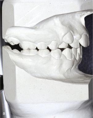 Modelos montado no centro para o planeamento de tratamento (dente persistente 53).