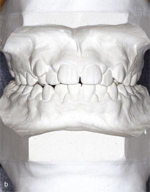 Modelli montati in centro per la pianificazione del trattamento (dente persistente 53).