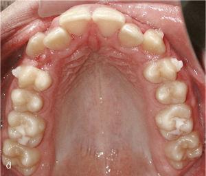situación intraoral no inicio do tratamento con invisalign e ataches nos dentes 13 e 23 e parénteses para a clase elástica II sobre os dentes 14, 24, 36 e 46.