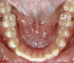 Situació intraoral a l'inici de l'tractament amb Invisalign i ataches a les dents 13 i 23 i brackets per elàstics de classe II a les dents 14, 24, 36 i 46.