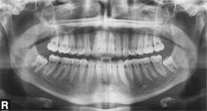 Radiografia panoràmica un cop finalitzat el tractament. Es va indicar l'extracció de les dents 38 i 48.