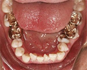 settore antrosuperior con i denti 11 e 21 in mesioversione e triangolo nero interdentale (A). Gli attacchi rettangolari verticali sono stati posizionati sui denti 11 e 21 e nell'anteriore adiacenti. Risultato del trattamento dopo aver raddrizzato i denti 11 e 21 e chiudere il triangolo nero (B).