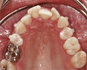 Settore antrosuperiore con i denti 11 e 21 in Mesioversione e triangolo nero interdentale (A). Gli attacchi rettangolari verticali sono stati posizionati sui denti 11 e 21 e nell'anteriore adiacenti. Risultato del trattamento dopo aver raddrizzato i denti 11 e 21 e chiudendo il triangolo nero (B).