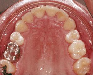 Antrouperior setor com 11 e 21 dentes em mesioversão e triângulo preto (a) . Anexos retangulares verticais foram colocados nos dentes 11 e 21 e no adjacente anterior. Resultado do tratamento depois de endireitar os dentes 11 e 21 e fechando o triângulo preto (B).
