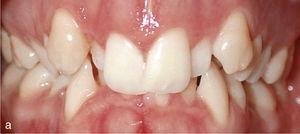 Vista intraoral da situación con dentes elevados 13 e 23 , conoid dentes 12 e 22 e falta de harmonía na liña gingival. Situación despois do tratamento con Invisalign: formación de arcadas harmoniosas e nivelación de altura gingival (b).