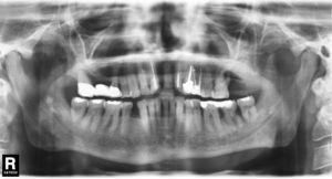 Radiografía panorámica: visualización de pequeñas estructuras hiperdensas bilaterales que se proyectan sobre el conducto dentario inferior inmediatamente por debajo del agujero mandibular correspondiente.