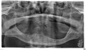 Radiografía panorámica: en la zona caudal del ángulo mandibular izquierdo se visualiza una estructura ovalada, hiperdensa, segmentada, lobulada y bien delimitada, patognomónica de un ganglio linfático calcificado.