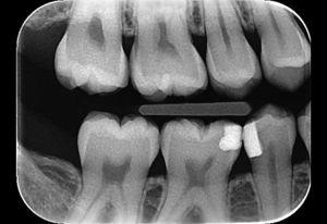 Radiografía de aleta de mordida del primer y del cuarto cuadrantes en la que se observa una lesión de caries en la cara mesial del diente 16.