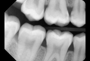 Radiografía de aleta de mordida del primer y del cuarto cuadrantes en la que se observa una lesión de caries en la cara mesial del diente 16.
