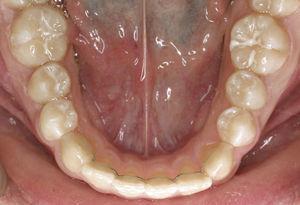 Alambre de retención fijo en la mandíbula entre el diente 33 y el diente 43.