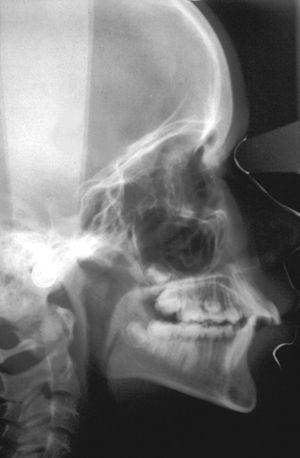 Telerradiografía lateral de la paciente de la figura 1a.