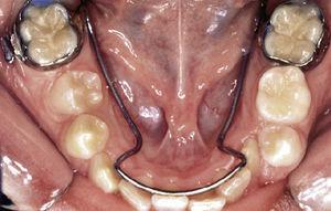 Mantenedor de espacio fijo para asegurar el espacio diferencial durante el recambio dentario en las zonas de soporte. De Radlansky33.