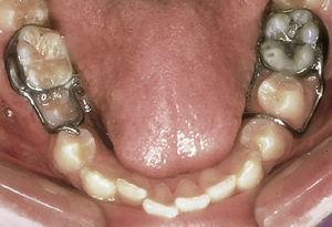 Mantenedores de espacio fijos individuales para asegurar el espacio para los dientes 25 y 45. Sin embargo, el mantenedor de espacio para el diente 35 es insuficiente, dado que el alambre obstaculiza la erupción del diente. De Radlansky33.