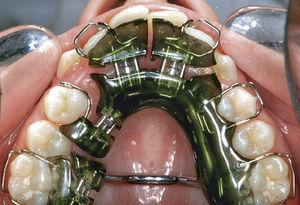 Colocación de placas activas para el ensanchamiento de la arcada dentaria superior y para crear espacio para la erupción dentaria. Los dientes 16, 15 y 14 sirven para el anclaje, los dientes 26 y 24 se someten a distalización activa y los dientes 12, 11, 21 y 22 se someten a protrusión activa. Una vez se ha creado el espacio necesario, los dientes 13 y 23 se alinearán correctamente durante su erup.
