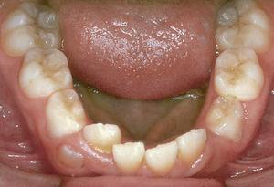 Déficit marcado de espacio debido a la pérdida precoz de los dientes 73 y 83, y migración de los dientes posteriores. En la mayoría de estos casos no hay más alternativas que la terapia con extracciones (suelen estar afectados los primeros molares).