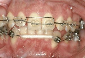 La aparatología fija no se suele colocar hasta después de la fase de erupción de los dientes permanentes (excepto los terceros molares) para reducir al mínimo el período de tratamiento.