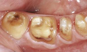 Situación clínica: Preparación finalizada en cuatro dientes posteriores de la arcada inferior derecha que van a recibir coronas con subestructura de dióxido de circonio.