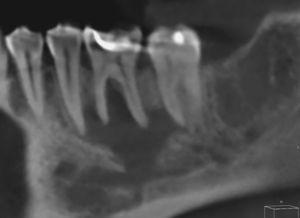 Tomografía volumétrica dental: MPR sagital oblicua.