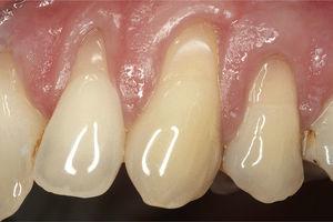 Cuello dental expuesto como consecuencia de abrasiones, que reacciona con hipersensibilidad a los estímulos aplicados.