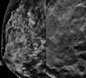 Mujer de 47 años. En la foto de la derecha observamos una imagen ampliada de la proyección oblicua mediolateral de mamografía convencional de mama derecha, donde se evidencia una mama con componente fibroglandular elevado, BIRADS III, en la que no se objetivan claros signos de malignidad. En la foto de la izquierda, con tomosíntesis, visualizamos claramente un nódulo espiculado, con retracción del parénquima vecino. Diagnóstico anatomopatológico de carcinoma ductal infiltrante.