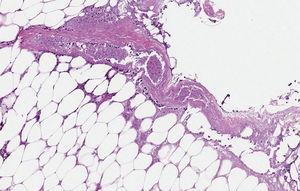 Tinción de hematoxilina-eosina, x13. Necrosis de tipo isquémico de pared vascular y tejido adiposo mamario.