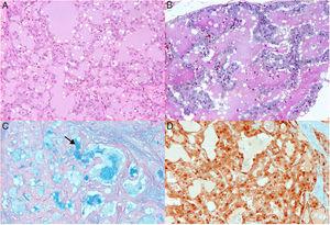 Upper pictures show histologic section treated with HE technique, notice microcysts covered by neoplastic cell (A). Dilated glands with abundant osinophilic material in the lumen (B). This is more evident colloidal iron staining (C). S-100 protein is expressed in nucleus and cytoplasm of neoplastic cells (D).
