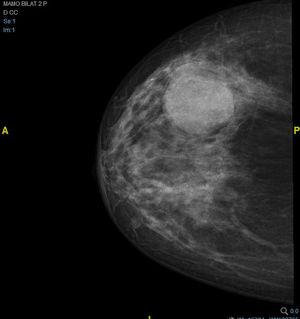 Mamografía en proyección anteroposterior de mama derecha, en la que se aprecia la lesión mamaria bien delimitada.