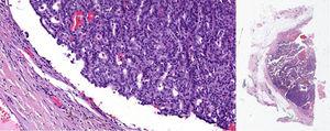 Carcinoma papilar capsulado de mama con crecimiento contenido por una cápsula fibrosa que focalmente conserva el revestimiento epitelial, pero sin células mioepiteliales basales ni en las papilas ni en la periferia de la lesión. Derecha: HE 10×. Detalle de la cápsula fibrosa. Izquierda: HE lupa.