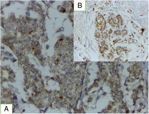 (A) Low expression of TRL5 in infiltrating duct carcinoma (ABCx400). (B) Positive expression of TRL5 in normal adjacent breast tissue (ABCx100).
