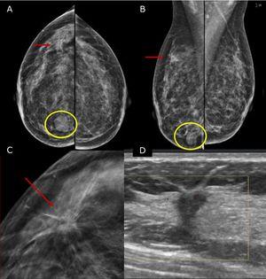 45 yo patient.first screening mammography. Digital Mammography in cranio caudal (A) and medio-lateral oblique (B) shows heterogeneously dense breasts with an oval shaped, well circumscribed margins, mass in the inner-inferior quadrant of the right breast (yellow circle, BI-RADS 2) and in the upper-outer quadrant of the same breast an architectural distortion which is better depicted in Digital Breast Tomosynthesis (C). The lesion had a sonographic appearance on B-mode (D) of a hypo-echoic mass, with micro-lobulated margins, posterior acoustic shadowing, and not-parallel orientation, highly suggestive for breast cancer (BI-RADS 5). The lesion was biopsied and histology revealed Invasive Ductal Cancer (ER+, PgR+, Her2neu−).