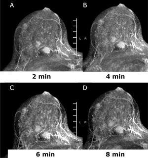 45 yo patient. (A–D) Dynamic contrast enhanced MRI at 2min (A), 4min (B), 6min (C) and 8min (D) after administration of gadolinium of the right breast. There are at least three oval shaped masses, with irregular margins and homogeneous contrast uptake with fast intake in the initial phase and wash-out in the delayed phase (BI-RADS 5). The lesions were histologically proven multifocal Invasive Lobular Cancer with small foci of lobular carcinoma in situ. Of note, only one lesion was identified at conventional imaging, mammography, and ultrasound (not shown).