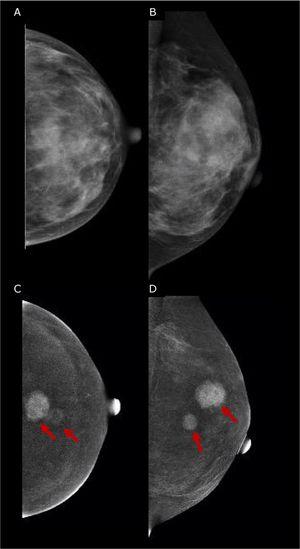 45 yo patient with histologically proven multifocal IDC of the Left Breast. (A, B) Low-energy digital mammography of the left breast, cranio-caudal (A) and medio-lateral oblique projections, shows dense breasts (ACR d): no suspicious mass or microcalcifications are detected. (C, D) Contrast-enhanced mammography in cranio-caudal (C) and medio-lateral oblique of the left breast shows two enhancing lesions in central-superior quadrants, demonstrating multifocal disease. The lesions were biopsied, and the histopathology proved Invasive Ductal Cancers (ER+, PgR+, Her2neg).