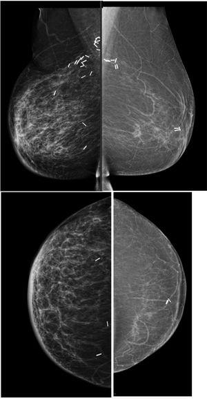 73 yo previous right WLE with melon slice mammoplasty bilateraly. Post surgical and RT changes in the right breast in the first surveillance screening mammography and fat necrosis in the left breast.