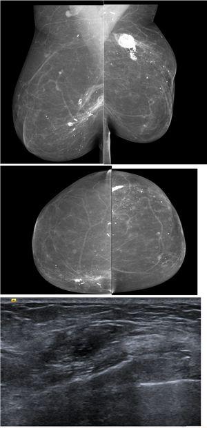 67 yo patient previous bilateral mastectomy with autologous reconstruction, presented with bilateral palpable lumps, ultrasound was performed and shows findings in keeping with calcified fat necrosis, bilateral mammography was performed to confirm the presence of fat necrosis and avoid the biopsy.