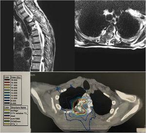 These images represent vertebral metastases before SBRT. a) Saggital plane MRI before treatment; b) Axial plane MRI before treatment; c) Patient's planning TCimage with dose distribution.
