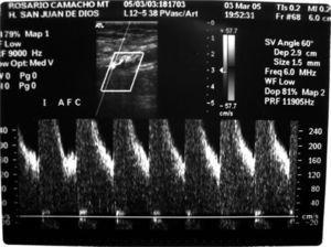 Estenosis del 80% de la arteria femoral común izquierda con placas de ateroma calcificadas.