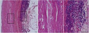 Características histopatológicas del aneurisma de aorta abdominal (AAA). Tinción con hematoxilina-eosina de la aorta abdominal de un paciente con AAA. El área recuadrada se muestra a la derecha a mayor aumento. El panel central muestra la ausencia de celularidad (CMLV) en la capa media de la pared vascular de estos pacientes. En el panel de la derecha se observa el importante infiltrado inmunoinflamatorio característico de la adventicia del AAA. Barras: 150μm.