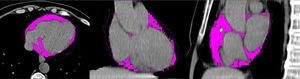 Tomografía axial computarizada. El color magenta muestra el tejido adiposo epicárdico. Imagen de archivo personal.