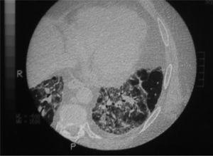 Tomografía computarizada de tórax que evidencia patrón en vidrio deslustrado e infiltrados parcheados en ambos lóbulos inferiores.