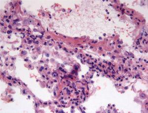 Capilaritis pulmonar: intersticio ensanchado con aumento del número de células. Nótense los leucocitos polinucleares, con la desproporción entre los leucocitos intersticiales y alveolares. Material hemático en la luz alveolar. (HE, ×100.)